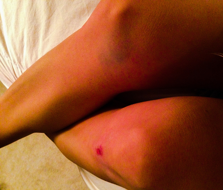 Legs Bumps & Bruises www.agutsygirl.com #HalfMarathon #WeRunSF