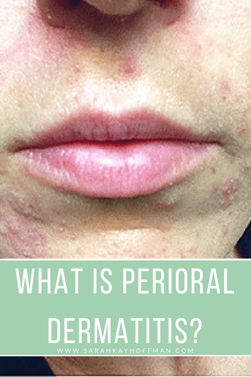 What is Perioral Dermatitis www.sarahkayhoffman.com #perioraldermatitis #skincare #SIBO #gutskin #guthealth