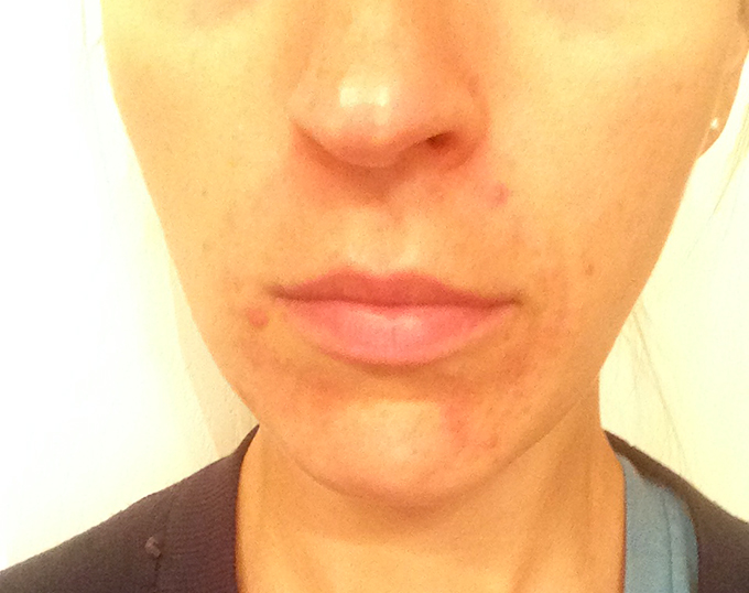 Perioral Dermatitis Update from using Earth Mama Angel Baby Nipple Butter via www.agutsygirl.com Skin