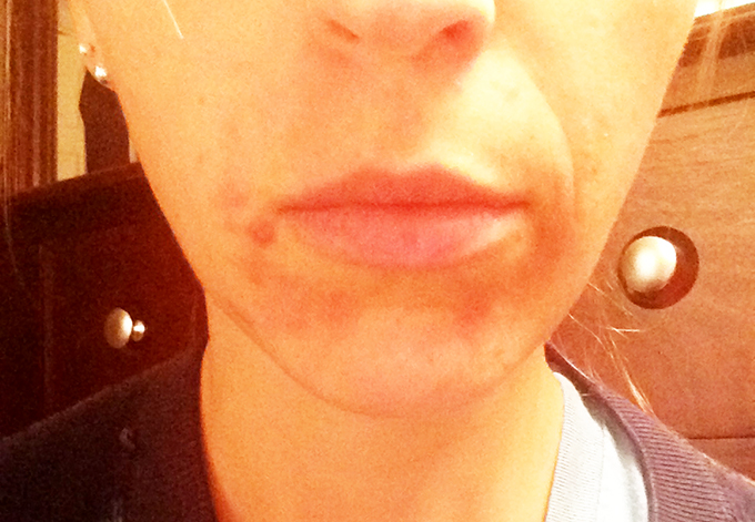 Perioral Dermatitis Update from using Earth Mama Angel Baby Nipple Butter via www.agutsygirl.com