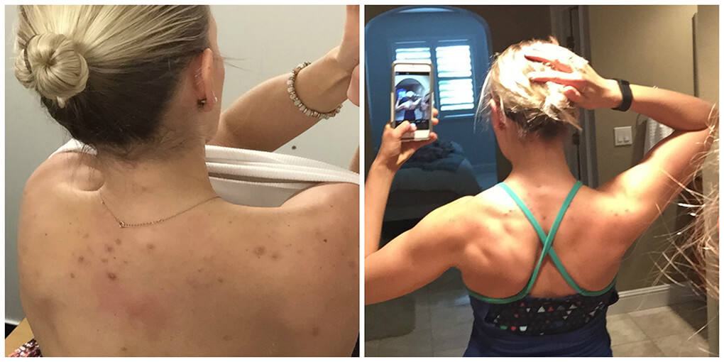 Healing Cystic Back Acne Naturally What I Learned During 30-Days Strict AIP Gut-Brain-Skin Axis sarahkayhoffman.com