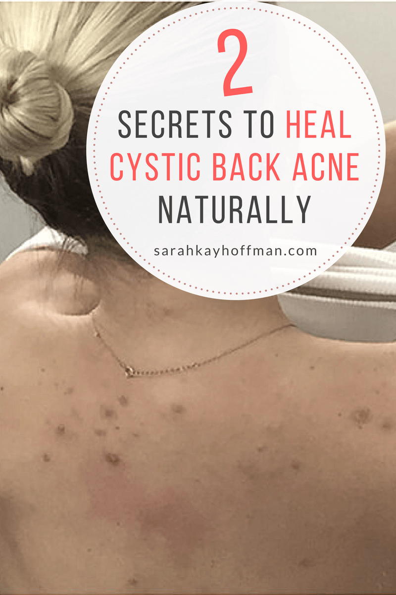 Healing Cystic Back Acne Naturally sarahkayhoffman.com 2 Secrets to Heal Cystic Back Acne Naturally