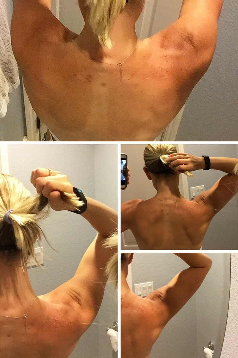 Healing Cystic Back Acne Naturally sarahkayhoffman.com