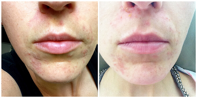 My Perioral Dermatitis Journey www.sarahkayhoffman.com beginning #sibo #perioraldermatitis #skincare #skinhealth