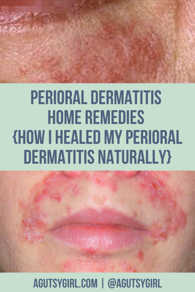 Perioral Dermatitis Home Remedies {How I Healed My Perioral Dermatitis Naturally} agutsygirl.com #perioraldermatitis