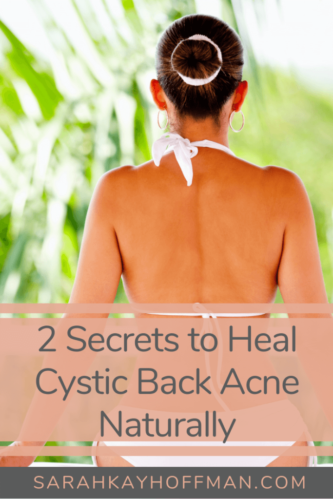 Healing Cystic Back Acne Naturally #acne #skincare #cysticacne #healthyliving 2 secrets for healing www.sarahkayhoffman.com