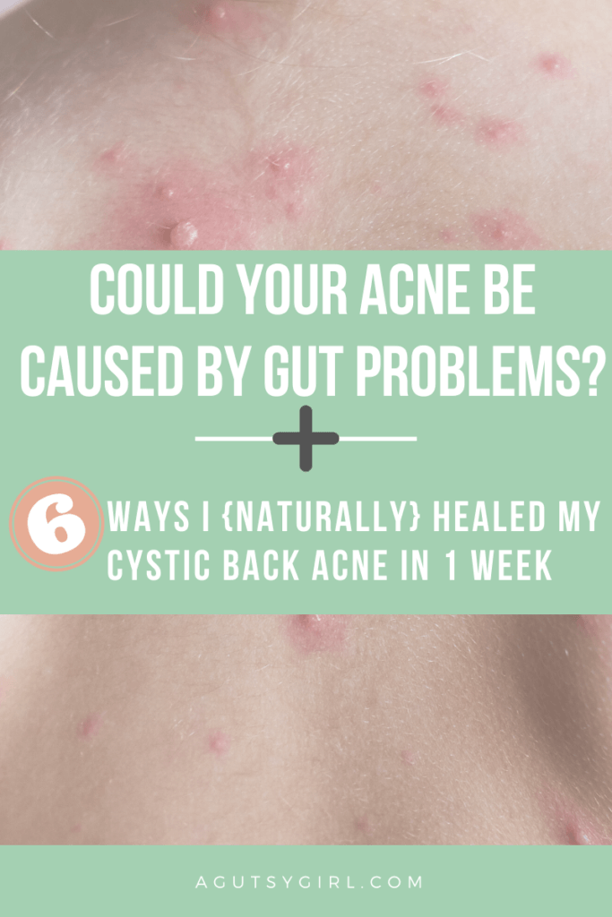 Could Your Acne be Caused By Gut Problems? agutsygirl.com #guthealth #acne #skincare #skin