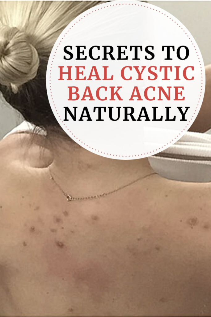 Secrets to heal cystic back acne naturally agutsygirl.com