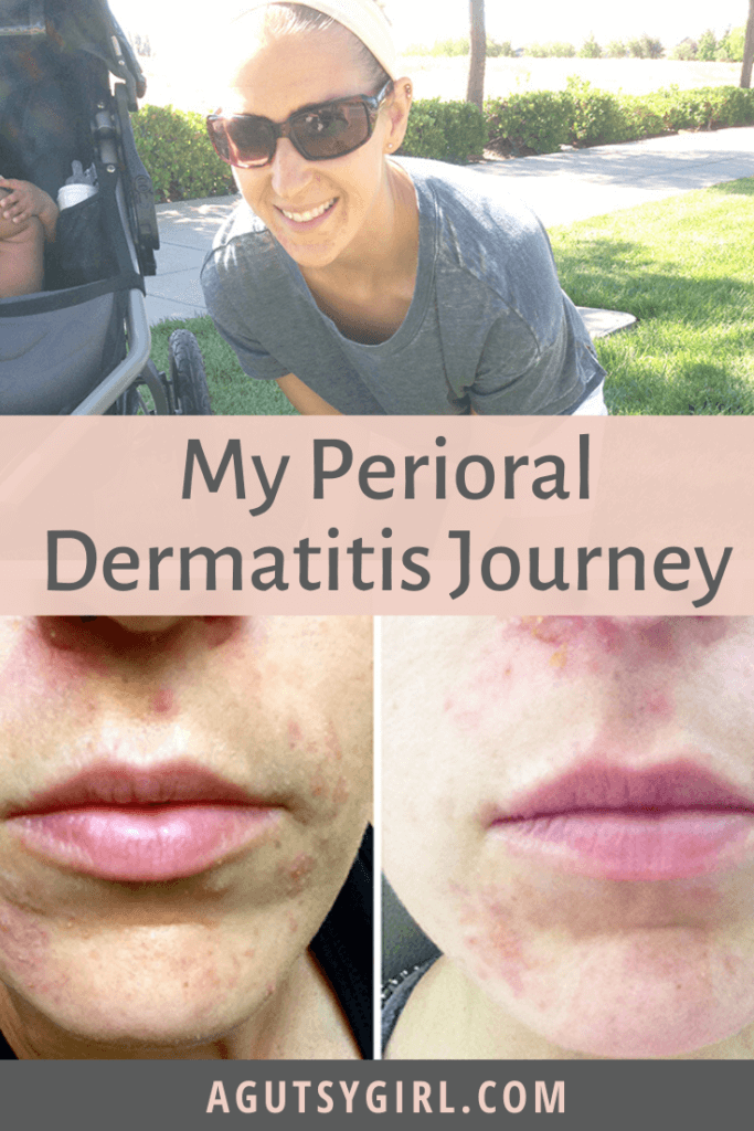 My Perioral Dermatitis Journey agutsygirl.com #acne #skincare #guthealth #perioraldermatitis