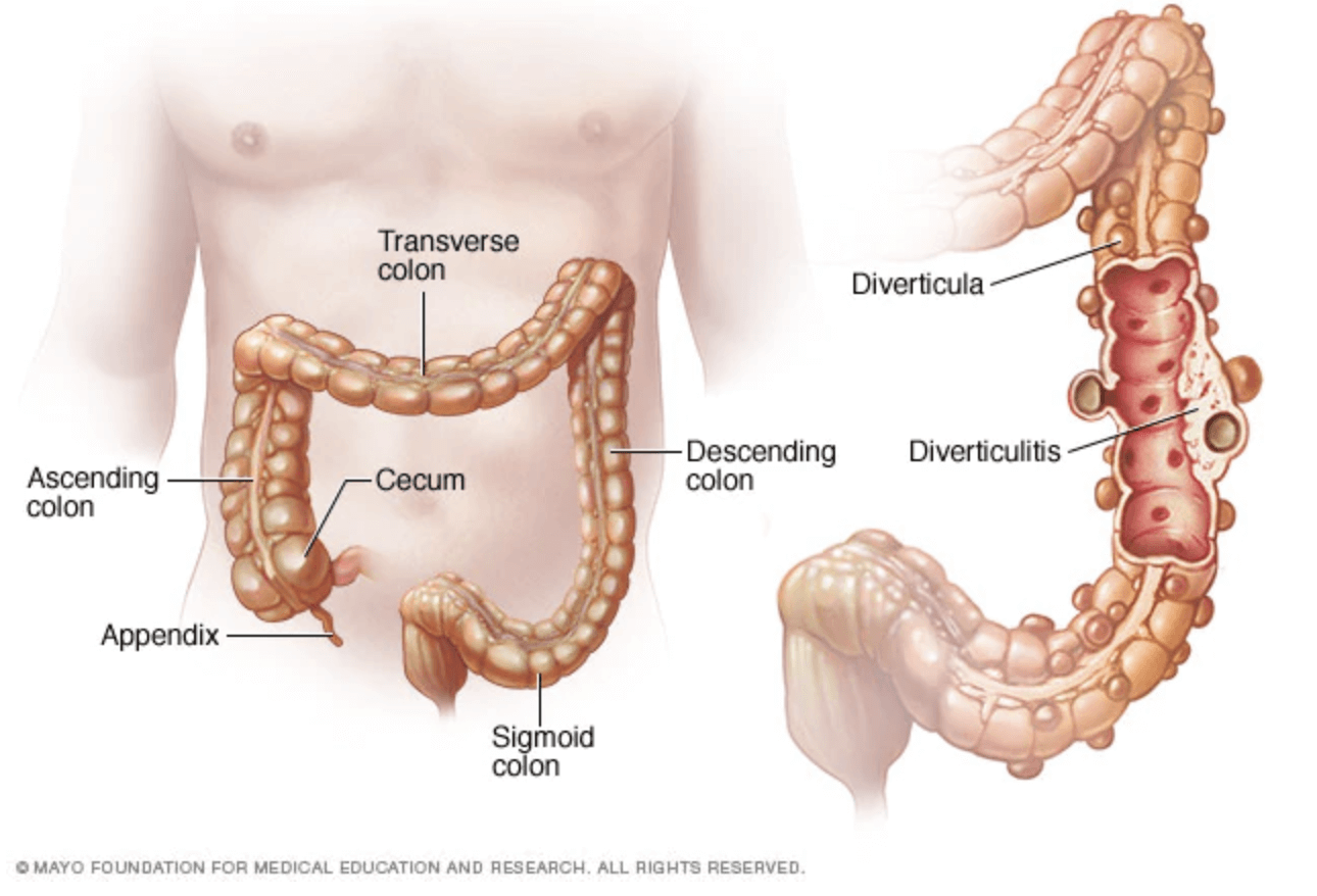 What is Diverticulitis agutsygirl.com Mayo Clinic image diverticula #diverticulitis #guthealth #gut