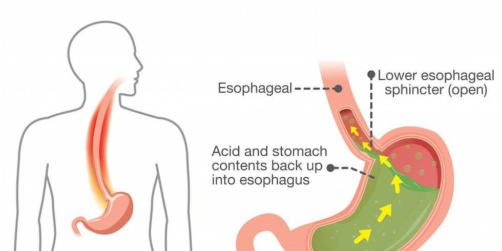 What is Acid Reflux agutsygirl.com Prevention Magazine #acidreflux #gerd #guthealth