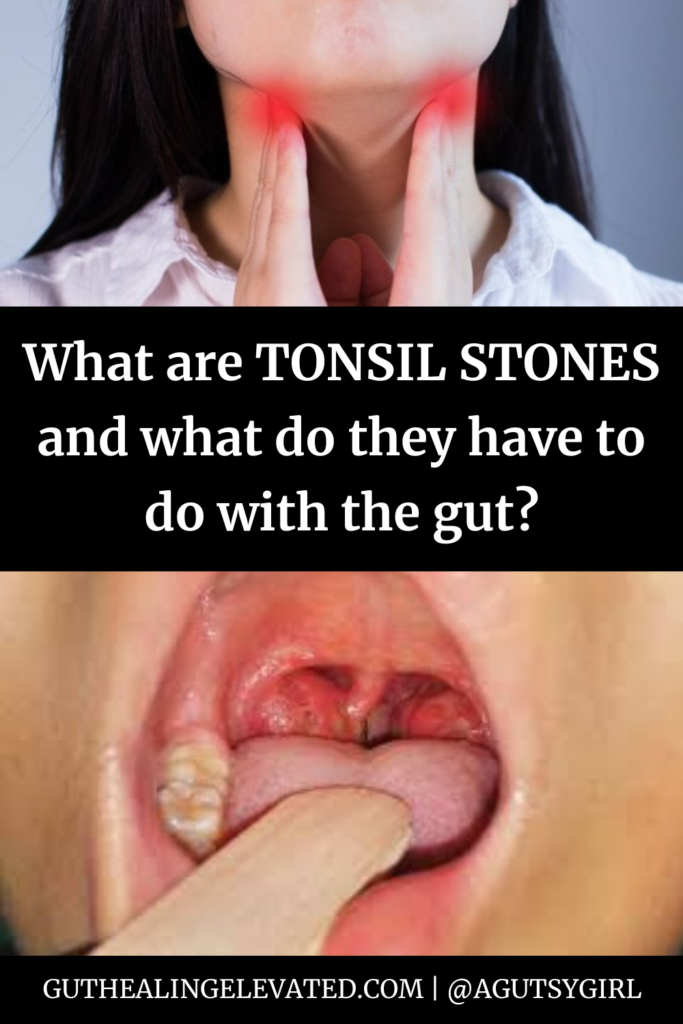 Home Remedies for White Spots on Tonsils agutsygirl.com