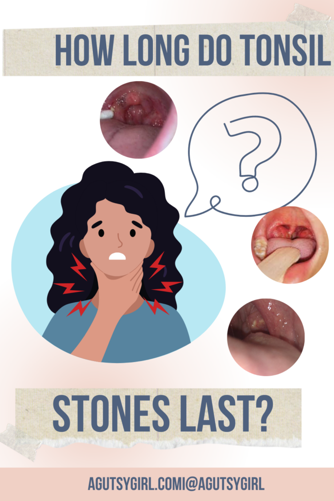 White Spots on Tonsils agutsygirl.com #tonsils #tonsil #tonsilstone