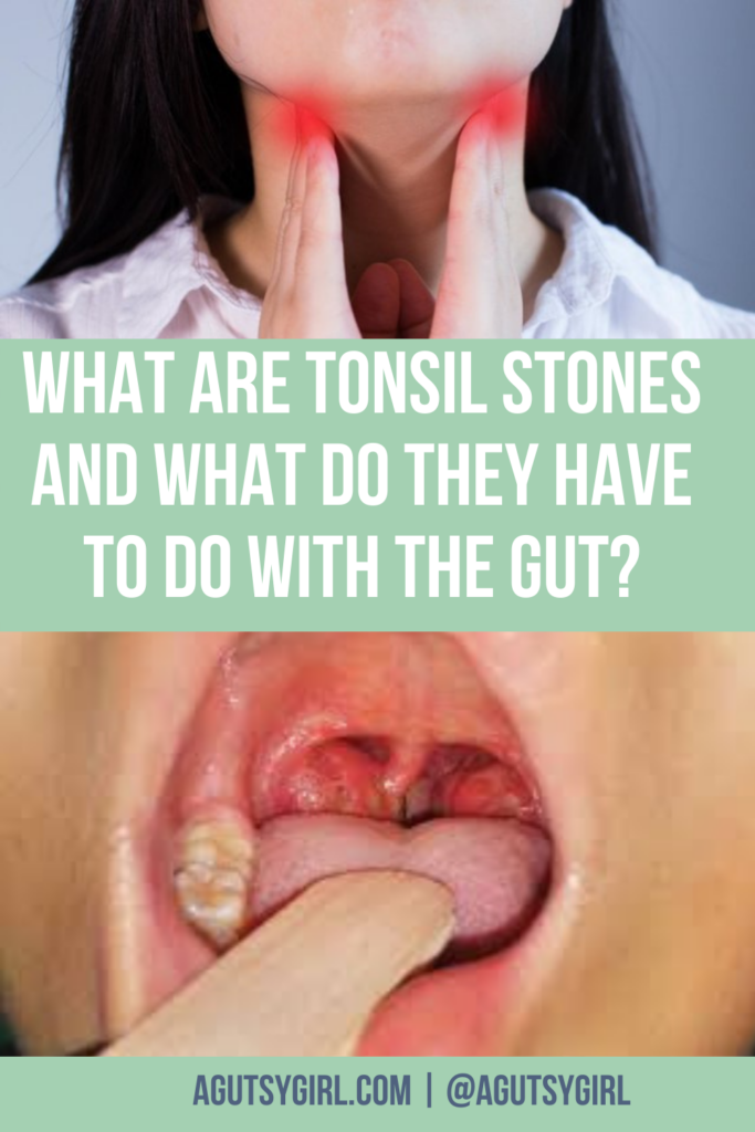 strep throat white spots on tonsils