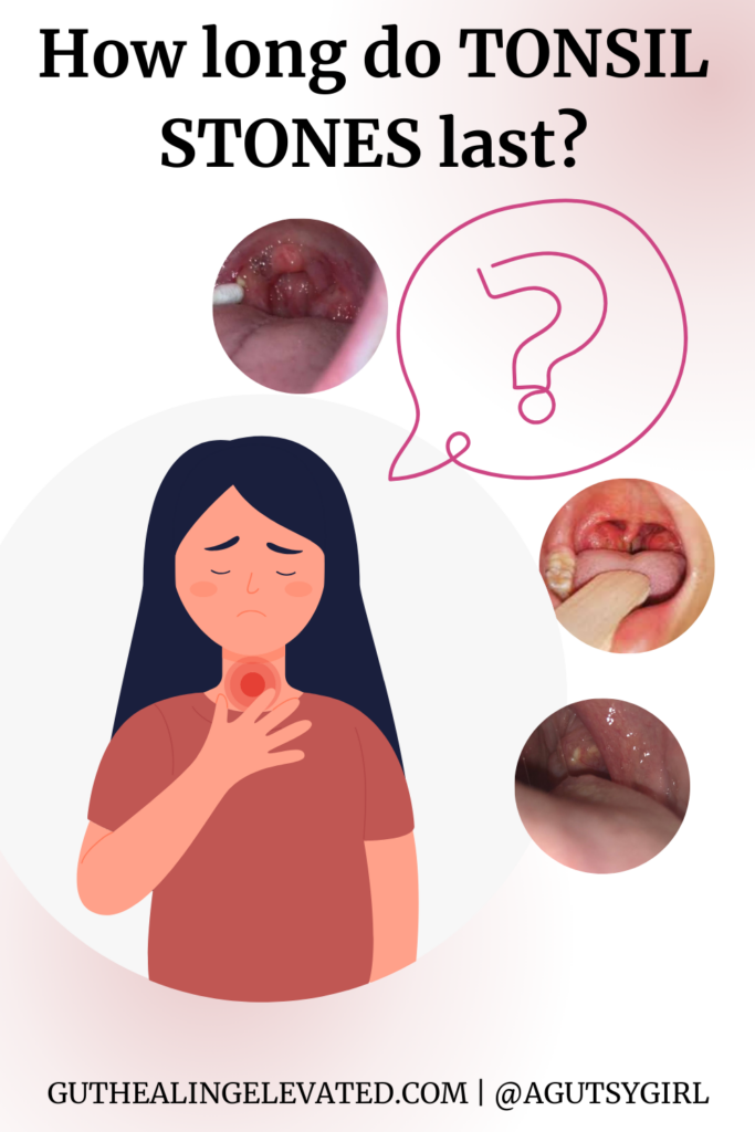 how long do tonsil stones last Home Remedies for White Spots on Tonsils agutsygirl.com